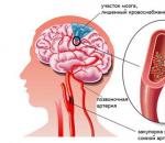 Лечение атеросклероза сосудов головного мозга – препараты