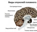 Опухоль головного мозга у детей — симптомы на ранних стадиях, причины, лечение