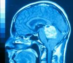 Рак головного мозга: первые симптомы, лечение и прогноз для жизни