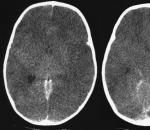 Причины и последствия отека мозга головы