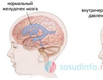 Гидроцефалия мозга у взрослых и детей: лечение, симптомы