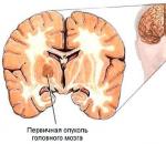 Рак головного мозга: симптомы и лечение