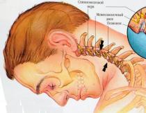 Головокружение при шейном остеохондрозе: симптомы
