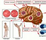 Рак головного мозга: симптомы на ранних стадиях и прогноз излечения