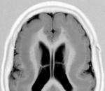 Аномалии развития головного мозга – синдром «двойной коры Зоны смежного кровоснабжения